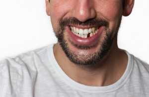 Resolving Tooth Gaps in Battersea